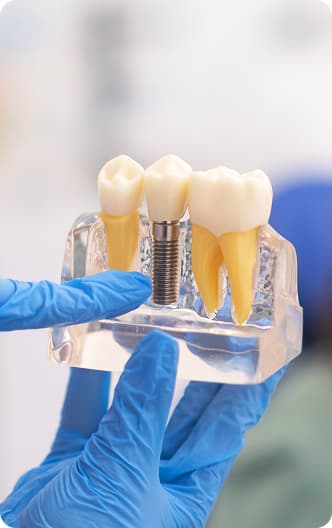 Dental Implants