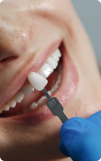 Emax veneers